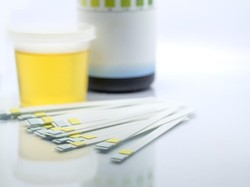 Warna Air Kencing Bisa Menandakan Risiko Batu Ginjal, Cek Sekarang