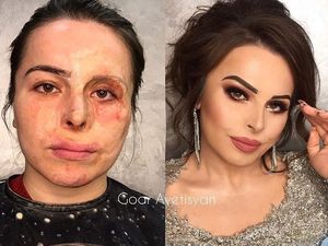 Foto: Transformasi Makeup Dramatis Penderita Kanker Hingga Korban Luka Bakar