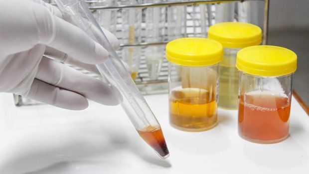 Reagent Strip for Urinalysis, Routine Urinalysis, urine test analysis in laboratory.