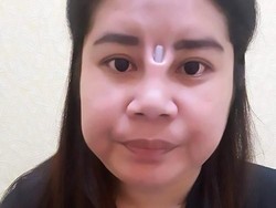 Gagal Operasi Plastik, Bagian Atas Hidung Wanita Ini Berlubang