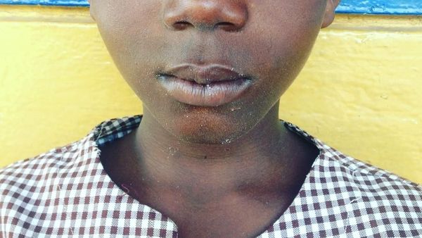Foto: Mata Biru Menyala Indah Para Penyandang Sindrom Waardenburg