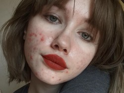 Foto Wajah Berjerawat dengan Pesan Inspiratif Ini Banjir Pujian Netizen