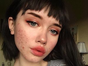 Kisah Inspiratif Wanita yang Berani dan PD Pamer Foto Berjerawat di Medsos