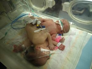 Haru, Kondisi Bayi Kembar Siam asal Palestina yang Akhirnya Terpisah