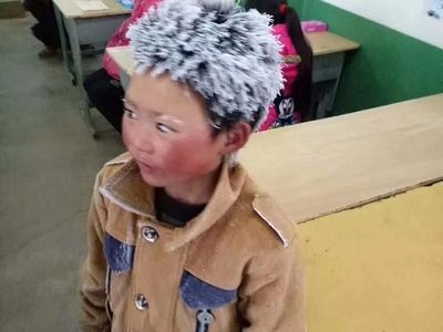 Kisah Mengharukan di Balik Bocah SD Berambut Es