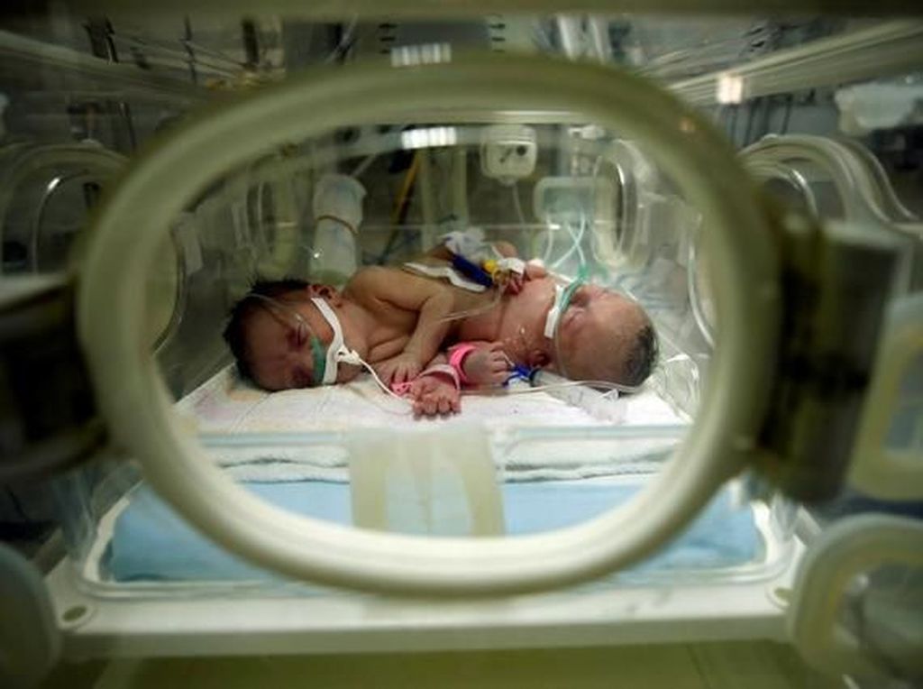 Bayi Kembar Siam dari Kendari Dirujuk ke RSUD dr Soetomo Surabaya