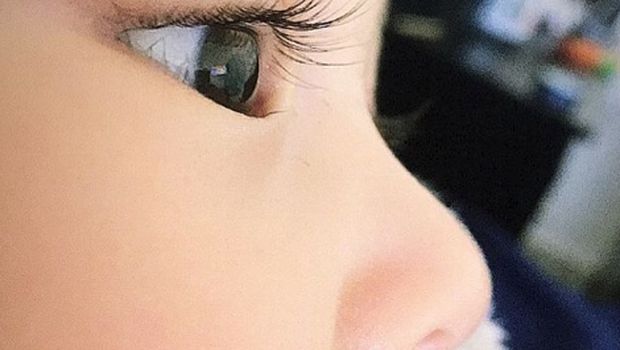 Cara Deteksi Dini Katarak pada Bayi