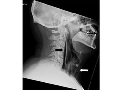 Kata Dokter THT soal Efek Tahan Bersin, Betulan Bisa Bikin Tenggorokan Pecah?