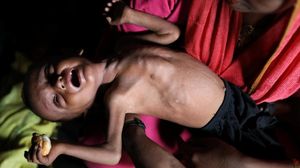Potret Anak-anak Rohingya yang Menderita Gizi Buruk