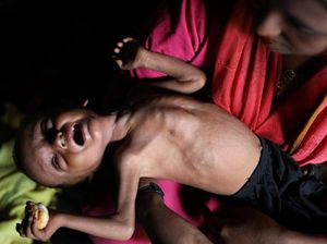 Potret Anak-anak Rohingya yang Menderita Gizi Buruk