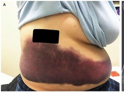 Wanita Ini Batuk Sangat Keras Sampai Tulang Rusuknya Patah