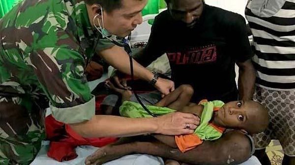 Begini Kondisi Balita Korban Gizi Buruk di Kabupaten Asmat