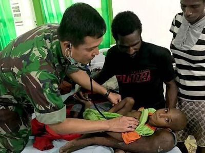 Begini Kondisi Balita Korban Gizi Buruk di Kabupaten Asmat