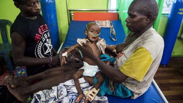 Miris, Begini Kondisi Anak Penderita Gizi Buruk di Papua