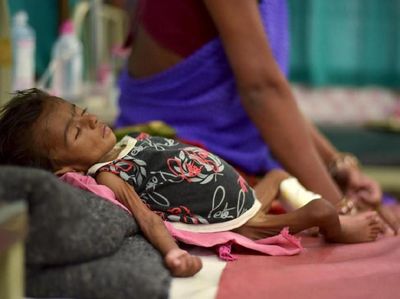 Foto Mirisnya Anak-anak Gizi Buruk di Berbagai Belahan Dunia