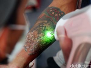 Foto: Ratusan Orang Ikuti Layanan Hapus Tato Foto: Ratusan Orang Ikuti Layanan Hapus Tato