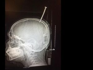 Sekrup Menancap di Kepala, Bocah Ini Cuma Berjarak 1 mm dari Kematian