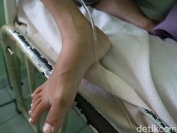 Menderitanya Fahri, Bocah 6 Tahun Berat Badan Hanya 10 Kg