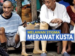 Berbagai Mitos tentang Kusta yang Harus Diketahui
