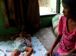 Balita 18 Bulan Penderita Gizi Buruk di Brebes Ini Bobotnya 5 Kg