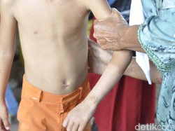 Diduga Terpapar Merkuri,  Bocah Desa di Sukabumi Terserang Gatal
