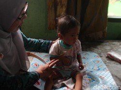 Jumlah Penderita Gizi Buruk Tertinggi di Jawa Tengah Ada di Brebes