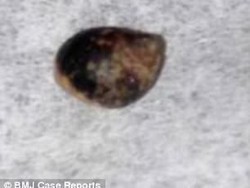Hii! Dokter Angkat Siput Kerdil dari Benjolan di Tubuh Bocah 11 Tahun