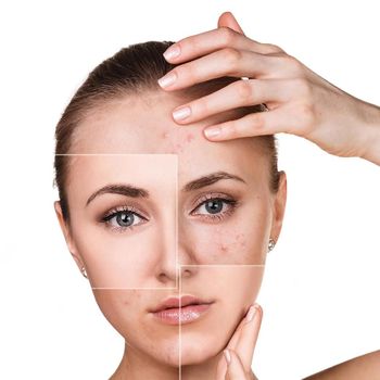 Woman with problem skin on her face before and after treatment over white background