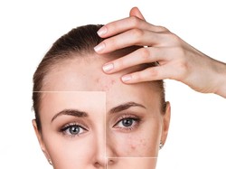 Ini Akibatnya Jika Terlalu Banyak Pakai Produk untuk Membasmi Jerawat