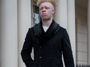Kisah Inspiratif Pria Albino, Dulu Dibully Kini Eksis di London Fashion Week