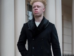 Kisah Inspiratif Pria Albino, Dulu Dibully Kini Eksis di London Fashion Week