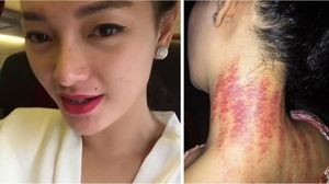 Dari Deddy Corbuzier Hingga Zaskia Gotik, Sederet Artis yang Gemar Kerokan