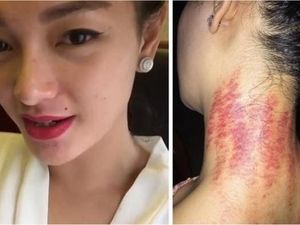 Dari Deddy Corbuzier Hingga Zaskia Gotik, Sederet Artis yang Gemar Kerokan