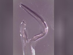 Hii! Dokter Angkat 14 Cacing dari Mata Wanita Ini