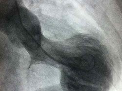 Foto Rontgen Jantung Pasien yang Diduga Kena Sindrom Patah Hati