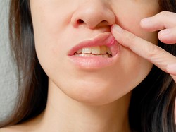 Tak Perlu Diolesi Obat, Atasi Sariawan dengan 10 Bahan Alami Ini!