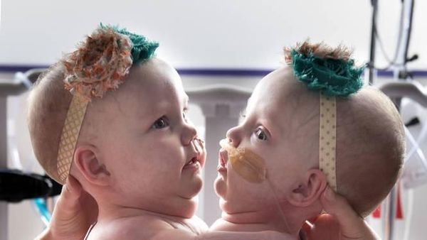 Momen Haru Saat Bayi Kembar Siam Sukses Jalani Operasi Pemisahan