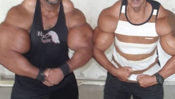 Potret Kakak Beradik yang Gemar Suntikkan Senyawa Kimia Demi Otot Besar