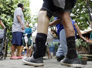 Setop Diskriminasi, Presiden Ditantang Salaman dengan Pasien Kusta