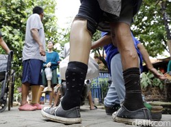 Setop Diskriminasi, Presiden Ditantang Salaman dengan Pasien Kusta