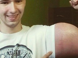 Suntikkan Minyak agar Otot Seperti Popeye, 1,3 Kg Otot Lengan Pria Ini Mati