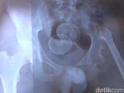 Ini Pengakuan Akmal, Pria dari Gowa yang Mengaku Bisa Bertelur