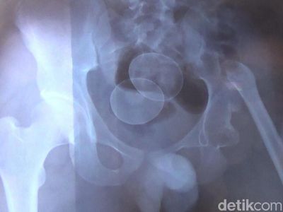 Ini Hasil Rontgen Remaja di Gowa yang Kembali Keluarkan Telur