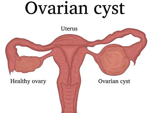 Illustration of a female disease - ovarian cysts