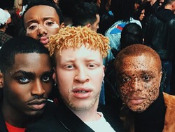 Dari Vitiligo hingga Albino, Empat Model Berpose dengan Berbagai Kondisi Kulit