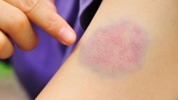 bruise on arm by domestic violence