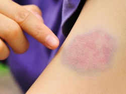 Kelainan Darah Langka Sebabkan Tubuh Nenek Ini Dipenuhi Memar Ungu