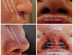 Suntik Filler Ngetren Lagi, Tompi Sebut Belasan Hidung Rusak Tiap Bulan