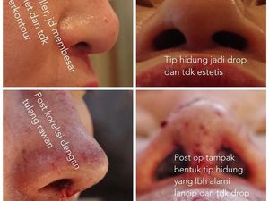 Suntik Filler Ngetren Lagi, Tompi Sebut Belasan Hidung Rusak Tiap Bulan Suntik Filler Ngetren Lagi, Tompi Sebut Belasan Hidung Rusak Tiap Bulan