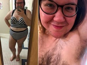 Kisah Wanita yang Di-bully karena Penuh Bulu Dari Dada Hingga Punggung